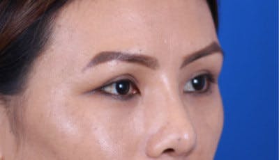 Blepharoplasty Before & After Gallery - Patient 24801515 - Image 4