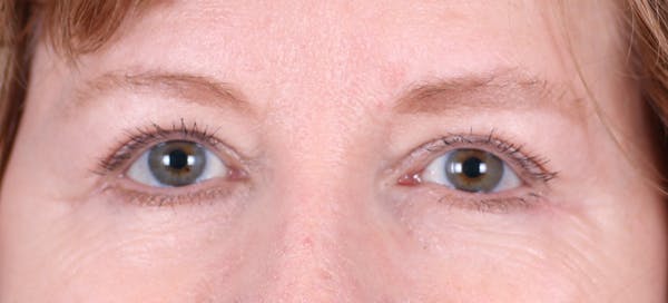 Blepharoplasty Before & After Gallery - Patient 24801518 - Image 2