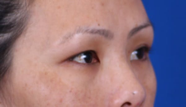 Blepharoplasty Before & After Gallery - Patient 24801515 - Image 3