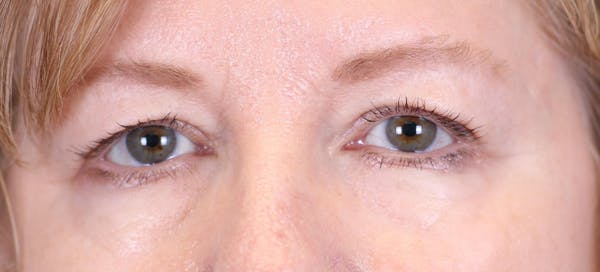 Blepharoplasty Before & After Gallery - Patient 24801518 - Image 1
