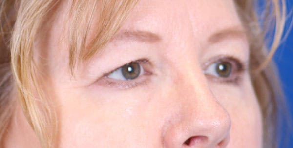 Blepharoplasty Before & After Gallery - Patient 24801518 - Image 3