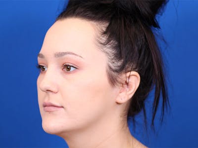 Genioplasty Before & After Gallery - Patient 24801532 - Image 1