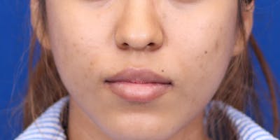 Genioplasty Before & After Gallery - Patient 24801533 - Image 1