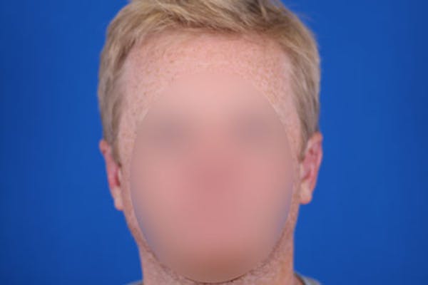 Otoplasty Before & After Gallery - Patient 24801672 - Image 2