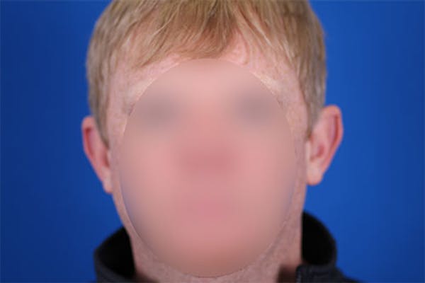Otoplasty Before & After Gallery - Patient 24801672 - Image 1