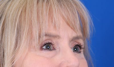 Brow Lift Before & After Gallery - Patient 24802613 - Image 6