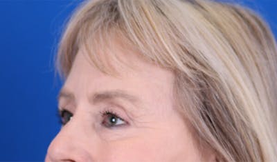 Brow Lift Before & After Gallery - Patient 24802613 - Image 4