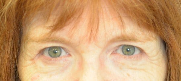 Brow Lift Before & After Gallery - Patient 24802614 - Image 1