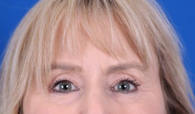 Brow Lift Before & After Gallery - Patient 24802613 - Image 2