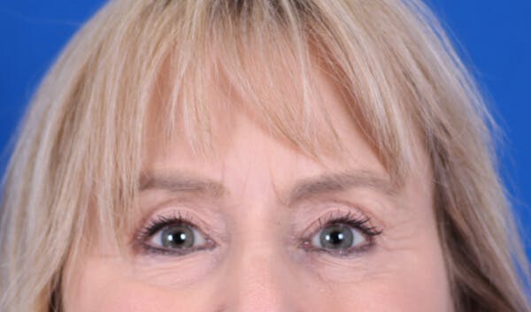 Brow Lift Before & After Gallery - Patient 24802613 - Image 2