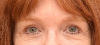 Brow Lift Before & After Gallery - Patient 24802614 - Image 2