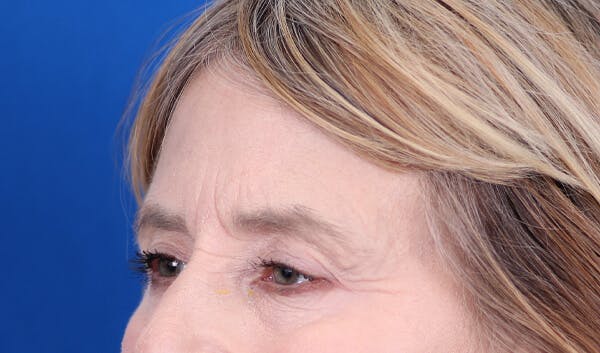 Brow Lift Before & After Gallery - Patient 24802613 - Image 3