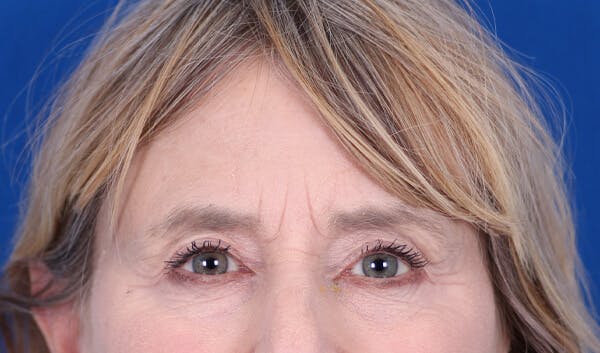 Brow Lift Before & After Gallery - Patient 24802613 - Image 1
