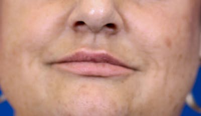 PermaLip (Lip Implants) Before & After Gallery - Patient 24802630 - Image 2