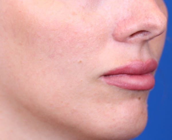 PermaLip (Lip Implants) Before & After Gallery - Patient 24802629 - Image 2