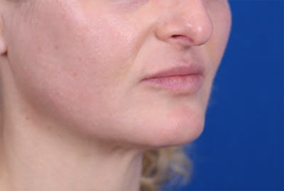 PermaLip (Lip Implants) Before & After Gallery - Patient 24802628 - Image 2
