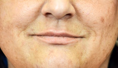 PermaLip (Lip Implants) Before & After Gallery - Patient 24802630 - Image 1