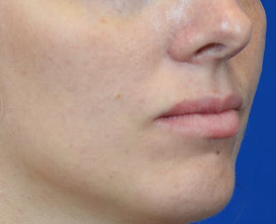 PermaLip (Lip Implants) Before & After Gallery - Patient 24802629 - Image 1