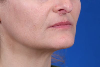 PermaLip (Lip Implants) Before & After Gallery - Patient 24802628 - Image 1
