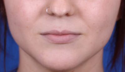 Lip Augmentation Before & After Gallery - Patient 24802644 - Image 1