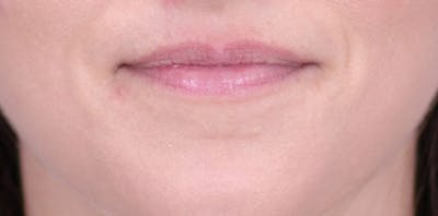 Lip Augmentation Before & After Gallery - Patient 24802645 - Image 1