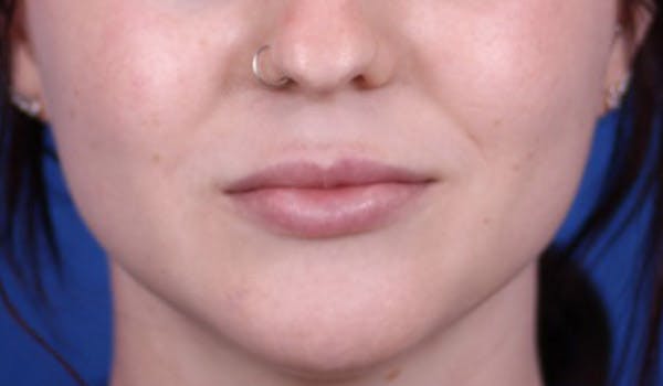 Lip Augmentation Before & After Gallery - Patient 24802644 - Image 2