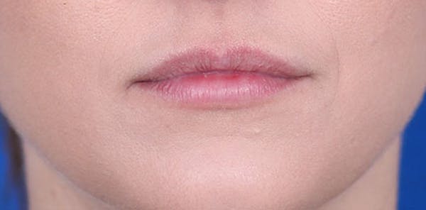 Lip Augmentation Before & After Gallery - Patient 24802645 - Image 2