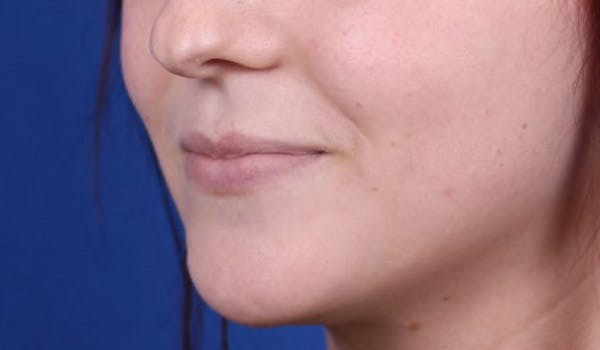 Lip Augmentation Before & After Gallery - Patient 24802644 - Image 3