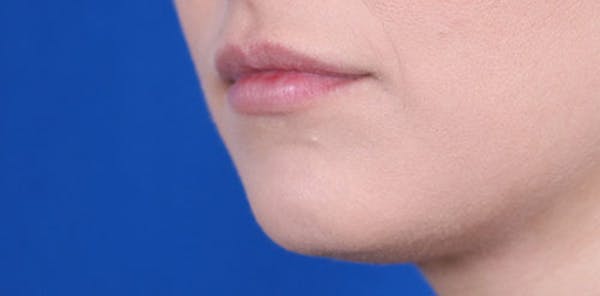 Lip Augmentation Before & After Gallery - Patient 24802645 - Image 4