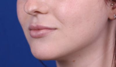 Lip Augmentation Before & After Gallery - Patient 24802644 - Image 4