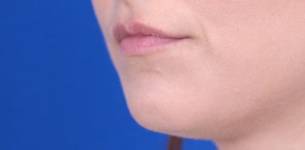 Lip Augmentation Before & After Gallery - Patient 24802645 - Image 3