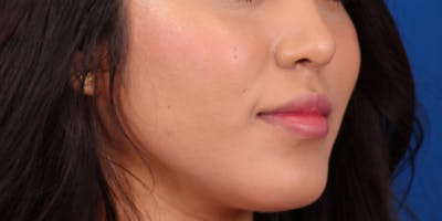 Buccal Fat Removal Before & After Gallery - Patient 24802713 - Image 4