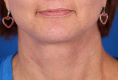 Facelift/Neck Lift Before & After Gallery - Patient 24802718 - Image 6