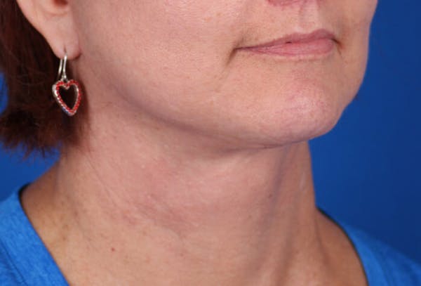 Facelift/Neck Lift Before & After Gallery - Patient 24802718 - Image 4