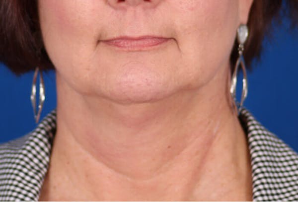 Facelift/Neck Lift Before & After Gallery - Patient 24802718 - Image 5
