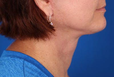 Facelift/Neck Lift Before & After Gallery - Patient 24802718 - Image 2