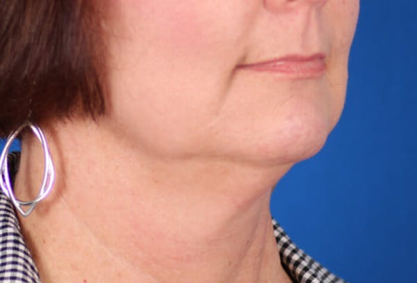 Facelift/Neck Lift Before & After Gallery - Patient 24802718 - Image 3