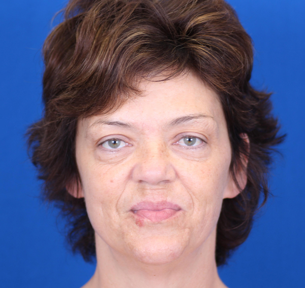 Facelift Omaha Facial Tightening Omaha Omaha Face