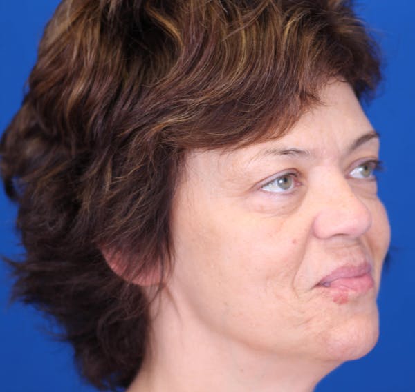 Facelift/Neck Lift Before & After Gallery - Patient 24802719 - Image 3