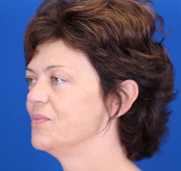Facelift/Neck Lift Before & After Gallery - Patient 24802719 - Image 5