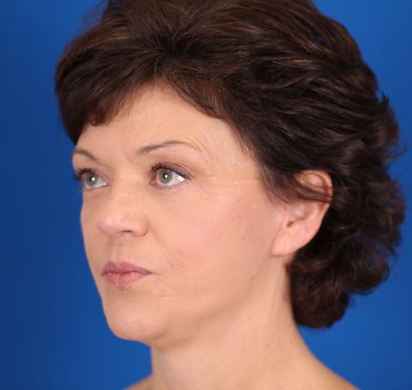 Facelift/Neck Lift Before & After Gallery - Patient 24802719 - Image 6
