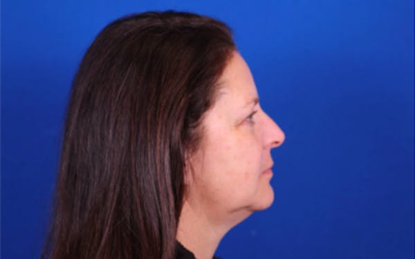 Facelift/Neck Lift Before & After Gallery - Patient 24802722 - Image 3