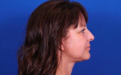 Facelift/Neck Lift Before & After Gallery - Patient 24802722 - Image 4