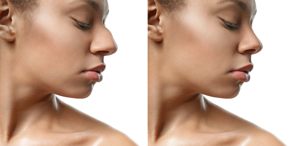 Omaha Facial Plastic Surgery & Medspa Blog | How Long Is Recovery From Rhinoplasty?