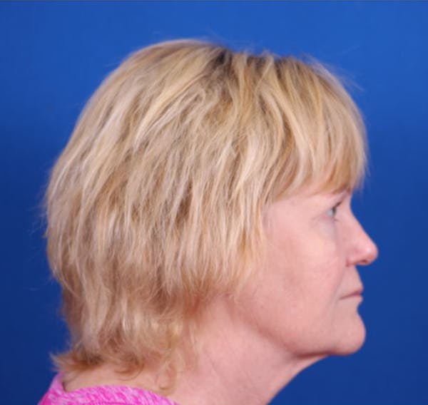 Facelift/Neck Lift Before & After Gallery - Patient 26562763 - Image 5