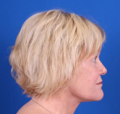 Facelift/Neck Lift Before & After Gallery - Patient 26562763 - Image 6
