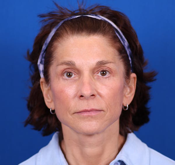 Facelift/Neck Lift Before & After Gallery - Patient 26562764 - Image 2