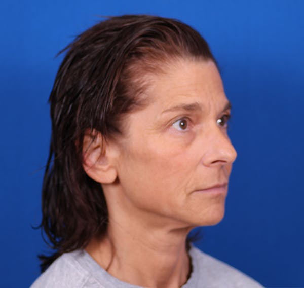 Facelift/Neck Lift Before & After Gallery - Patient 26562764 - Image 3