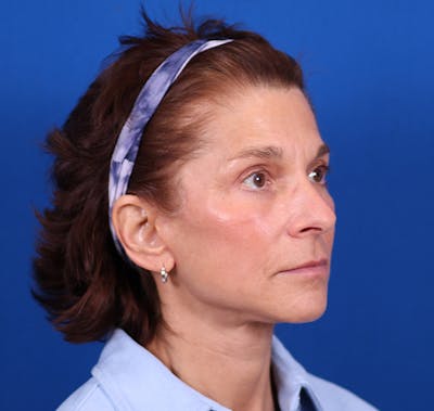 Facelift/Neck Lift Before & After Gallery - Patient 26562764 - Image 4