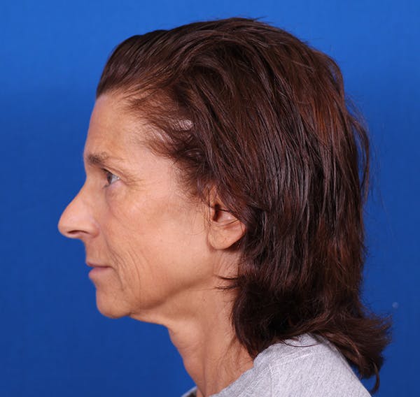 Facelift/Neck Lift Before & After Gallery - Patient 26562764 - Image 5